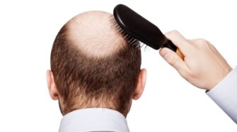 Chute de cheveux : découverte de la protéine responsable de la calvitie et des cheveux gris