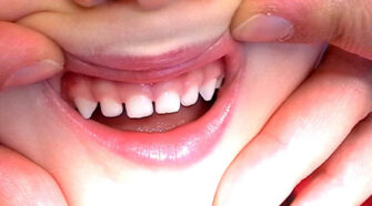 Montrez-moi vos dents et je vous dirai quel âge vous avez : une étude italienne révèle des années de molaires