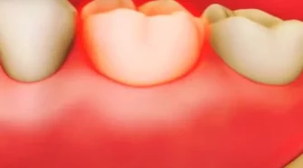 Comprendre et prévenir les dents pourries