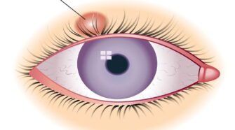 Guérir naturellement un Chalazion: Les meilleurs traitements à domicile pour vaincre ce trouble oculaire