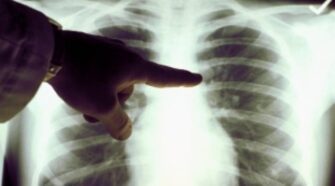 Radiographie des Poumons : Comprendre l&rsquo;Essentiel pour un Mode de Vie Sain