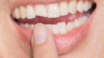 Comment réparer et prévenir les dents fissurées ?