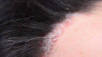 Infection du cuir chevelu : reconnaître les signes en images