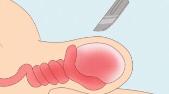 Comment traiter naturellement la mycose testiculaire ?