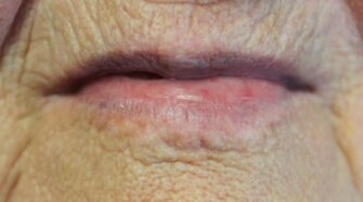 Pourquoi ai-je les lèvres noires : causes et traitements possibles
