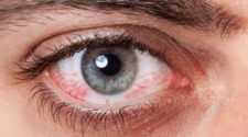 Le CBD peut-il réduire les yeux rouges ?
